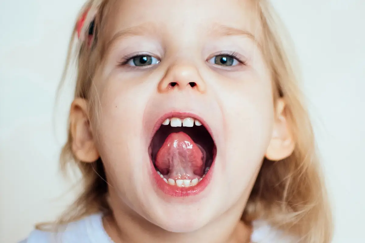 Tethered Oral Tissues | Therapy Matters NY SLP PC